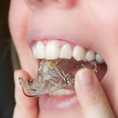 Einsatz der losen Zahnspange